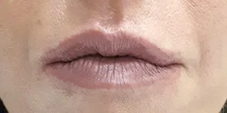 השפתיים אחרי הטיפול