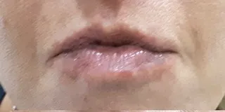 השפתיים לפני הטיפול