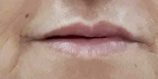 השפתיים אחרי הטיפול