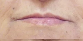 השפתיים לפני הטיפול